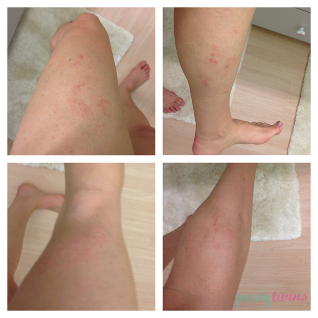 legs-eczema