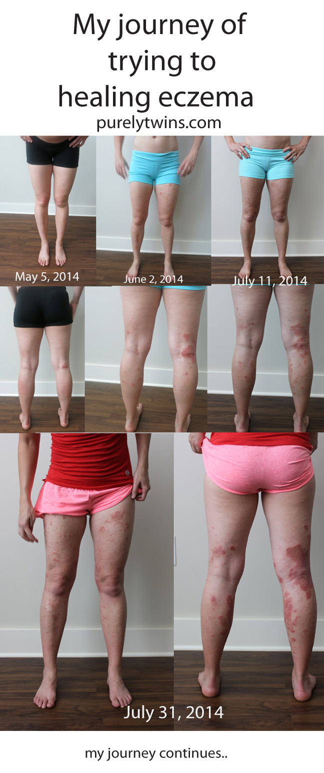 my journey to heal eczema on legs