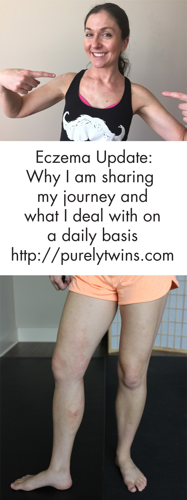 why-i-share-my-eczema-journey-what-i-deal-with-everyday-living-with-eczema