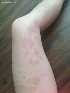 red patches on left leg